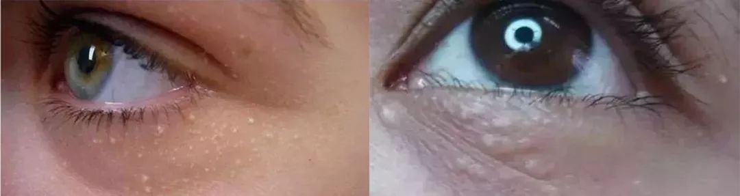 涂眼霜会引起汗管瘤吗,涂眼霜会引起眼部斑吗