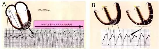 常见心律失常的识别和处理,心衰合并恶性心律失常的治疗策略