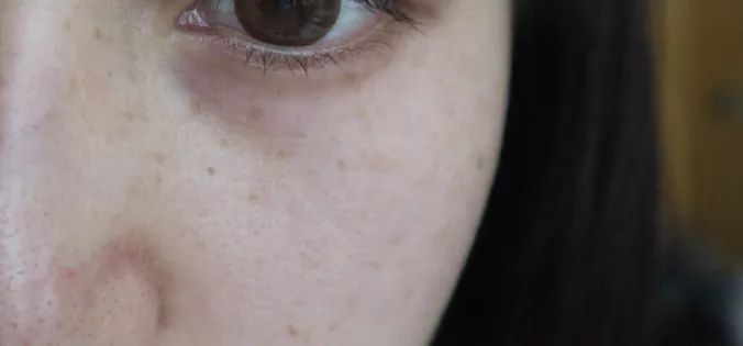 5个祛斑小妙招淡化晒斑雀斑痘印,晒斑痘印怎么消除的最快方法