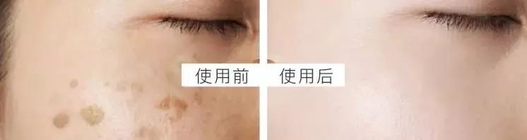 5个祛斑小妙招淡化晒斑雀斑痘印,晒斑痘印怎么消除的最快方法