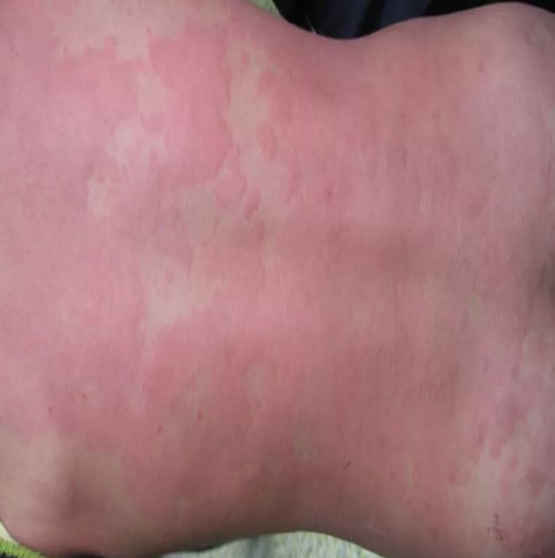 中医治疗荨麻疹一定要透疹,荨麻疹止痒大揭秘