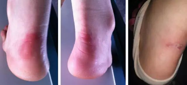 防磨脚神器隐形贴,防磨脚神器磨脚膏