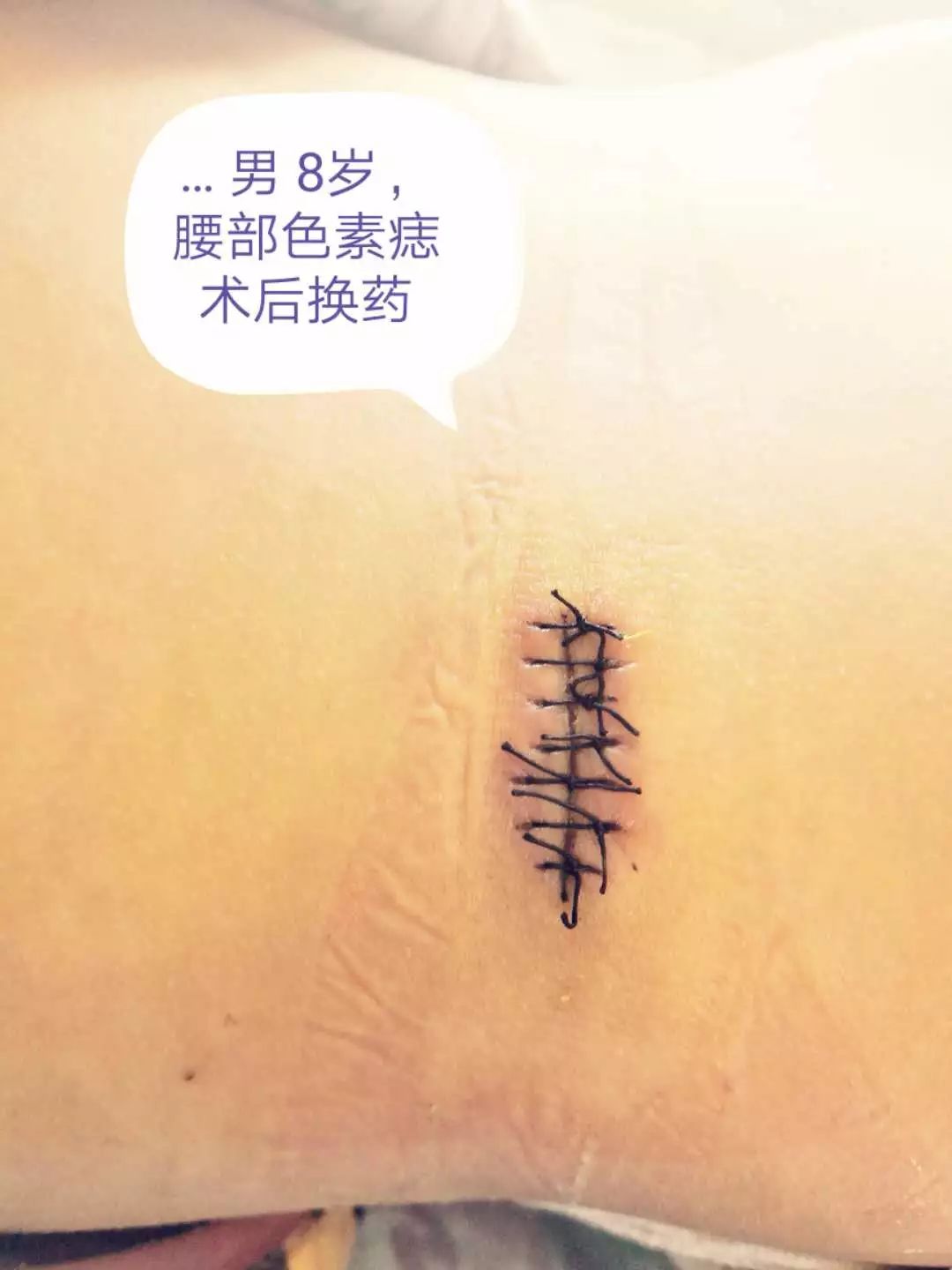 小小黑痣该不该治？该如何治？