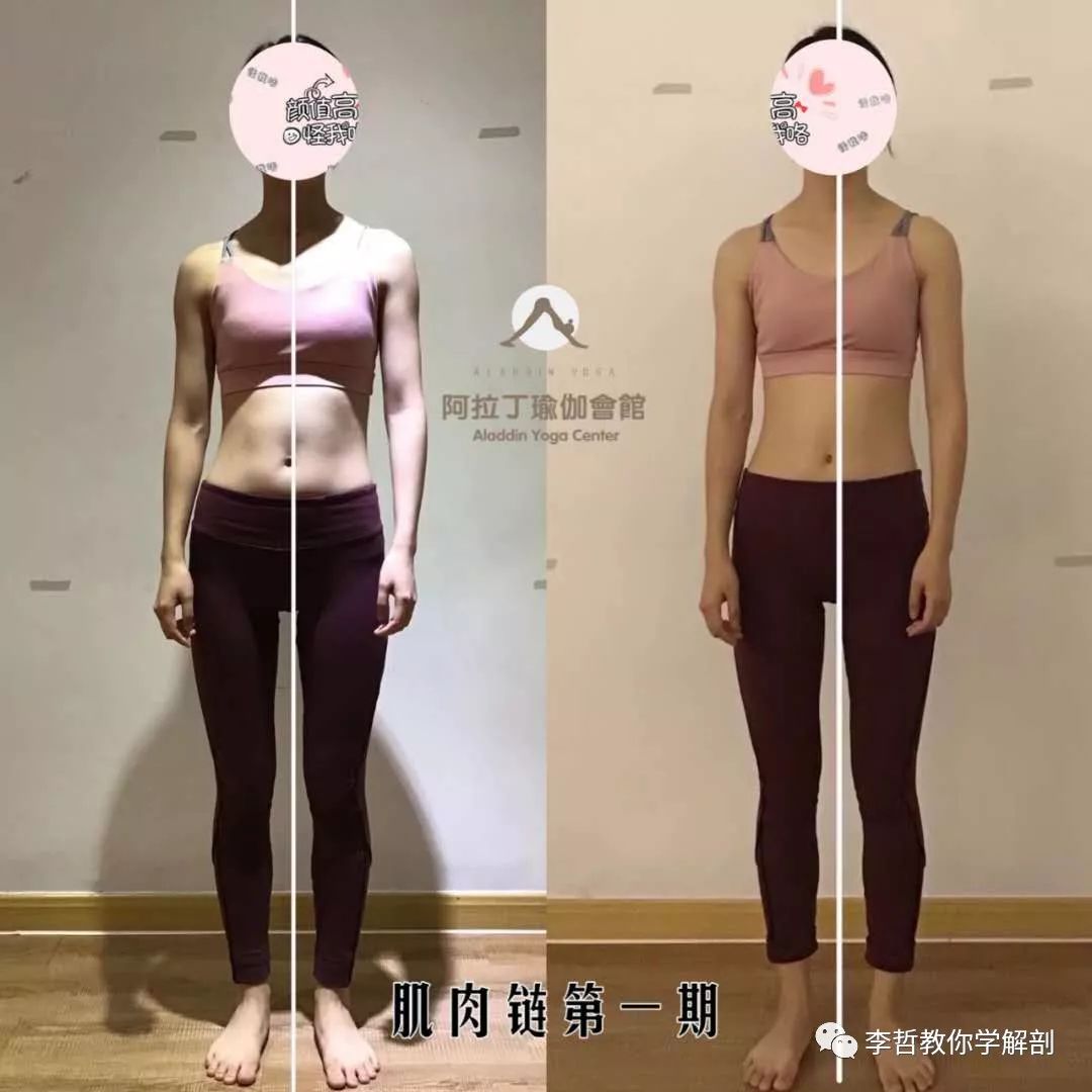 腰间盘突出脊柱侧弯康复训练,螺旋肌肉链训练治疗腰椎间盘突出