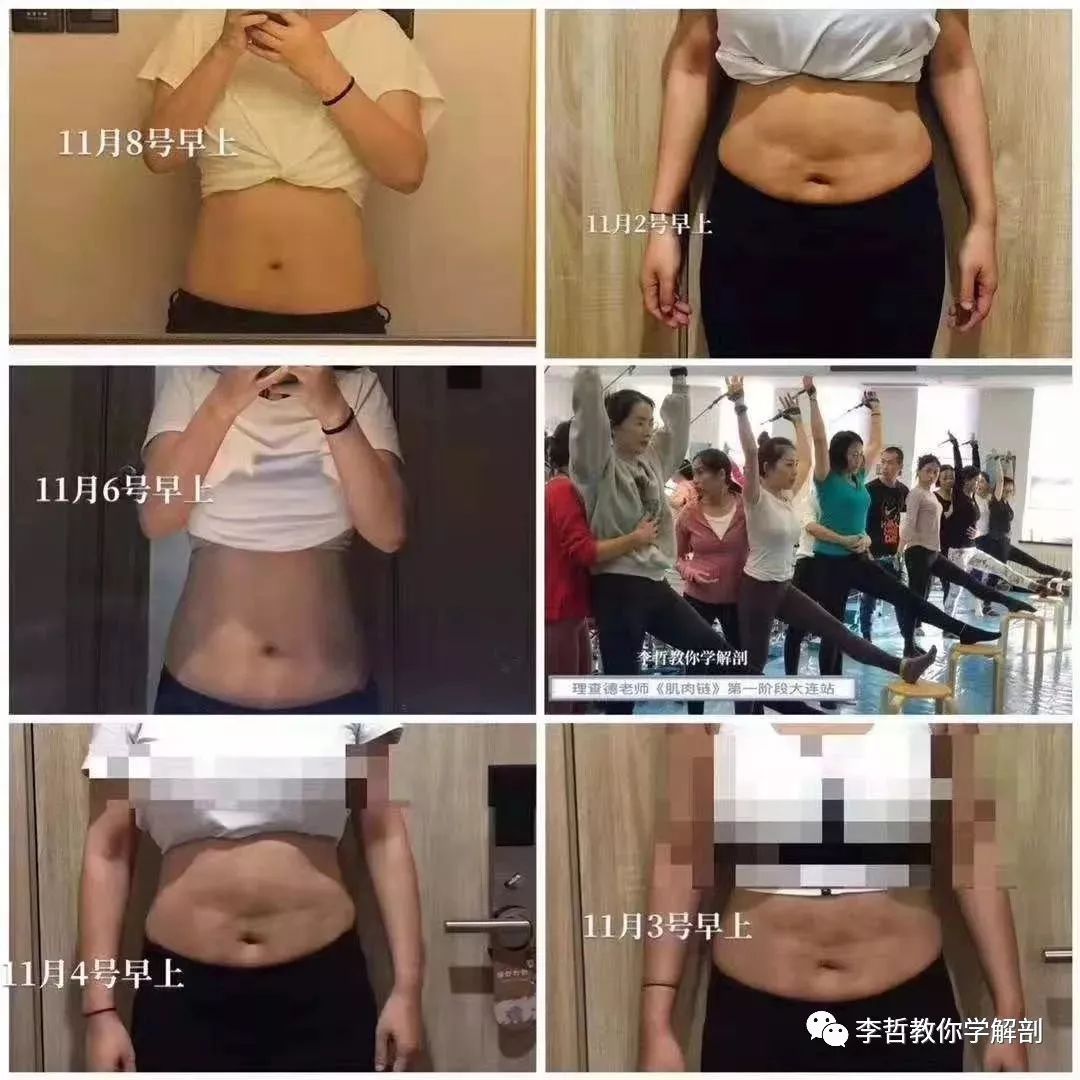 腰间盘突出脊柱侧弯康复训练,螺旋肌肉链训练治疗腰椎间盘突出