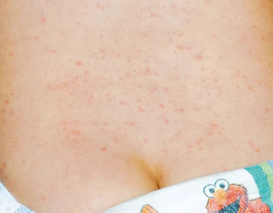 宝宝高烧后身上起疹子是怎么回事,宝宝高烧不退脸上有红点