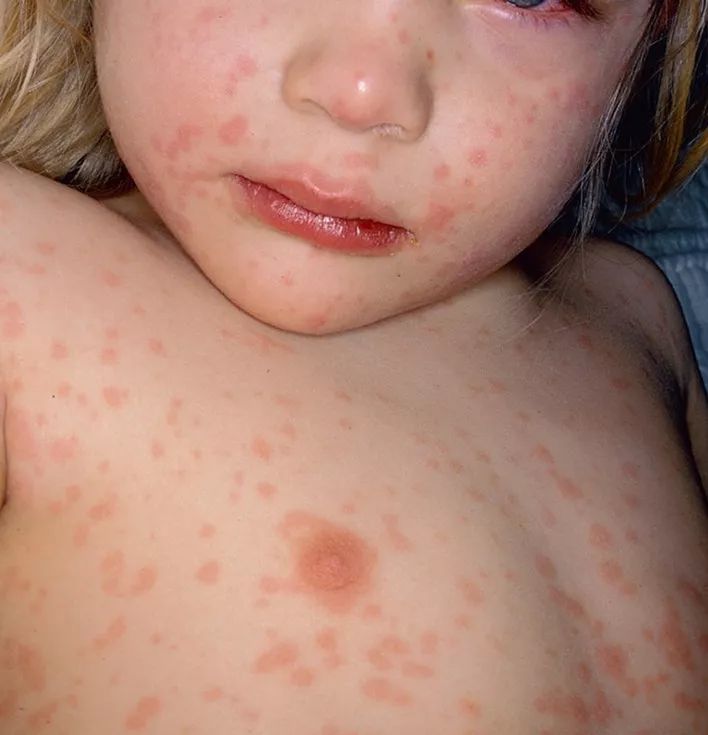 宝宝高烧后身上起疹子是怎么回事,宝宝高烧不退脸上有红点