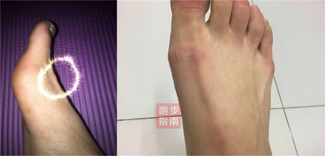 跑步一只脚踝内侧疼痛是怎么回事,跑步引起脚底局部筋疼痛