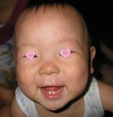 春天幼儿出疹怎么治,孩子出疹与季节有关的情况