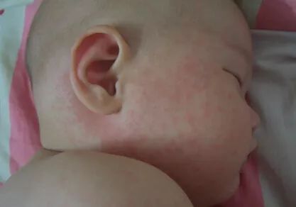 春天幼儿出疹怎么治,孩子出疹与季节有关的情况