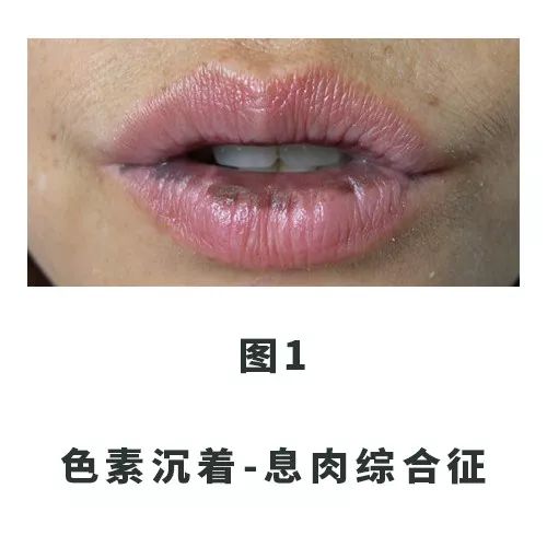 口唇出现黑斑是怎么回事,口唇内壁有黑斑