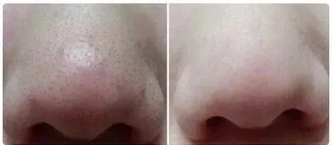 拨黑头工具草莓鼻,去黑头神器真的能吸出黑头