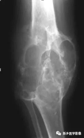 骨骼疾病怎么调理最有效,骨骼坏死最佳治疗方法