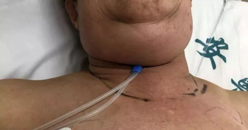 男子挤破疖子感染进icu,女子挤痘痘险些丧命紧急救援