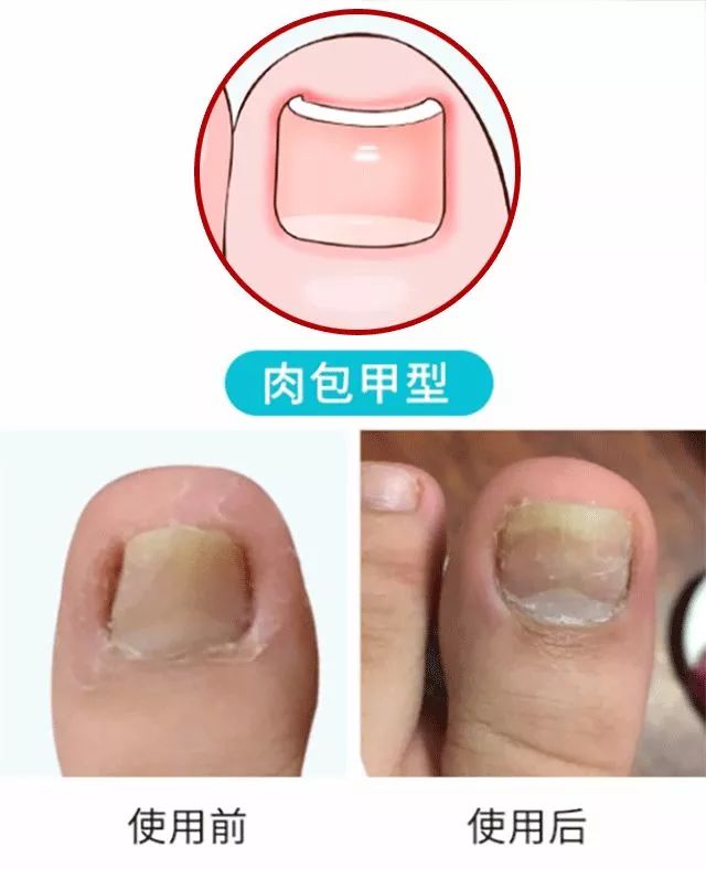 小脚趾甲长在肉里一碰就疼怎么办,指甲扎到肉里怎么处理