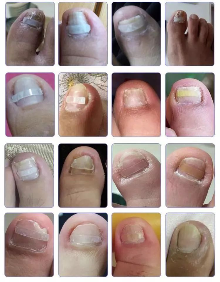 趾甲扎进肉里了，一碰就痛？用它一贴，1分钟止痛，趾甲往外长，再也不扎痛了！