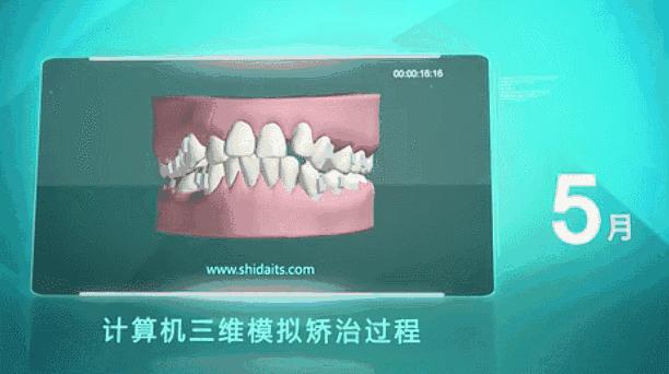 暑期矫牙季来啦你准备好了吗,暑期矫牙特惠