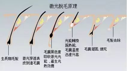 常见的美容激光项目,脉冲激光治疗后的注意事项
