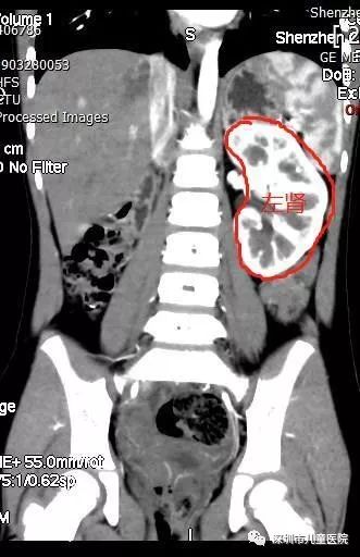 六岁的她每天都用“姨妈巾”,罪魁祸首是……家长注意,这怪病“偏爱”女孩