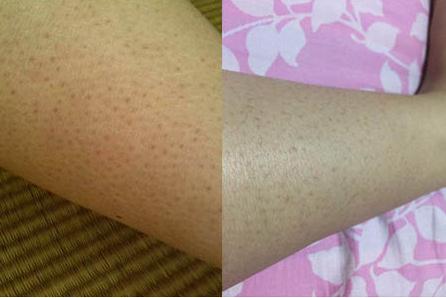 鸡皮肤严重夏天穿什么,夏天鸡皮肤发红