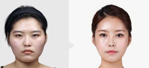 全球产能最大的玻尿酸企业是什么,全球最大玻尿酸研发基地