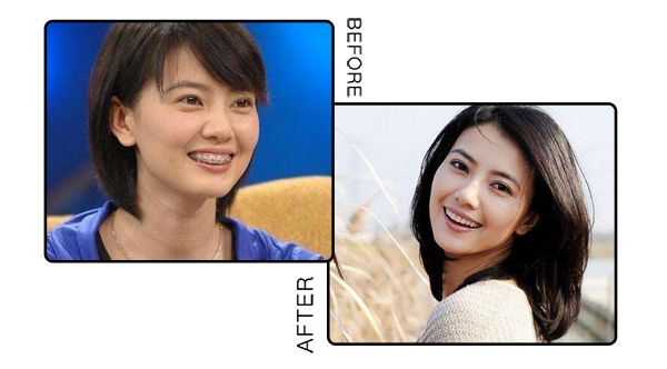 戴牙套整牙的全过程,隐形牙套换头