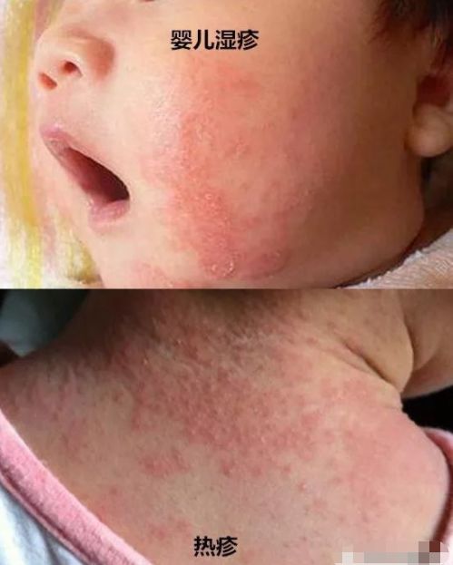 婴儿湿疹和热疹的区别在哪里,婴儿湿疹和热疹区别在哪里
