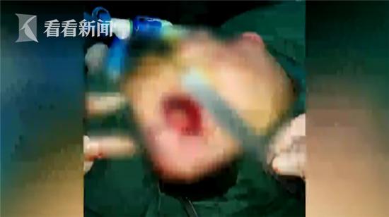 嘴唇上长了黑斑警惕某些部位病变,上嘴唇起了一个瘤说是癌症