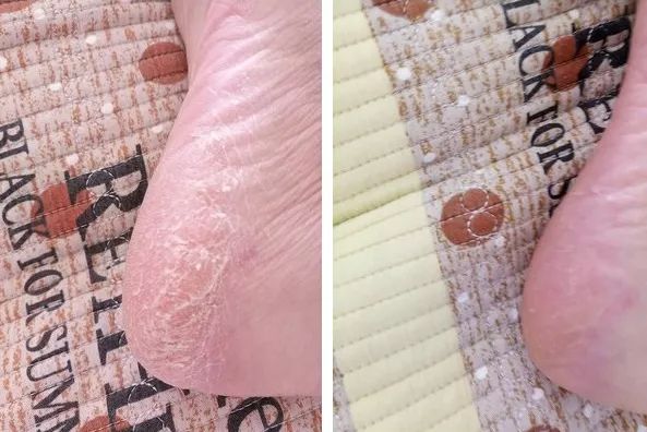 脚后跟套上这个“*钟金**罩”夏季穿鞋嫩到反光！干裂、老茧、死皮都没了！