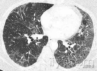 胸部解剖及常见疾病影像表现,胸部影像学基础知识