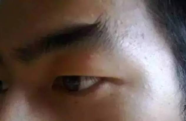 从眉毛看出疾病的征兆,小孩掉眉毛可能是大病预兆