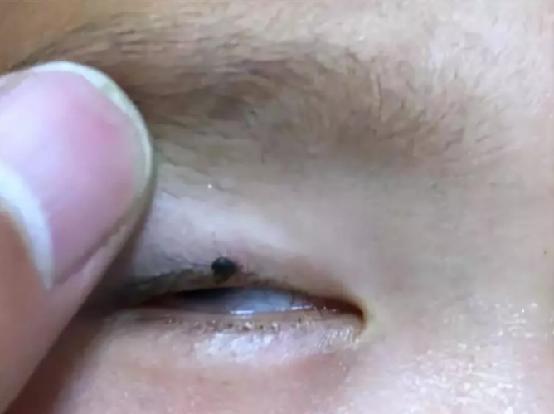 孩子7岁突然眼皮长了个黑点,2岁小孩眼睛上突然长了一颗黑痣