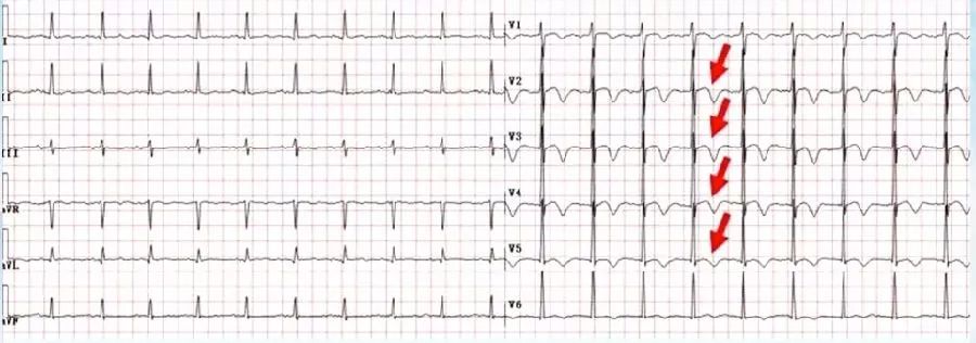 陈静：胸痛心电图的诊断与鉴别诊断｜CCIF2019