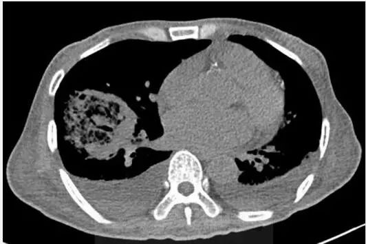 肺空洞性实变是什么原因,肺空洞症状