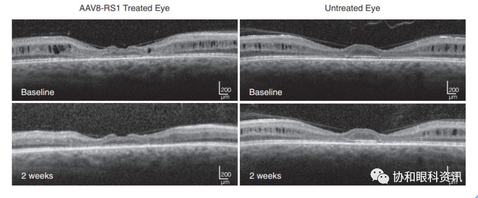 文摘速递丨X-连锁视网膜劈裂基因治疗的I/IIa期临床试验