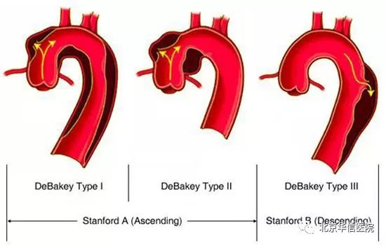 主动脉夹层最终是怎样致命的,主动脉夹层出院科普小知识