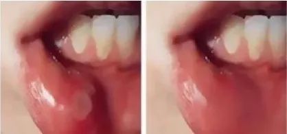 牙龈肿了出血口臭牙黄用什么牙膏,牙龈上火牙膏