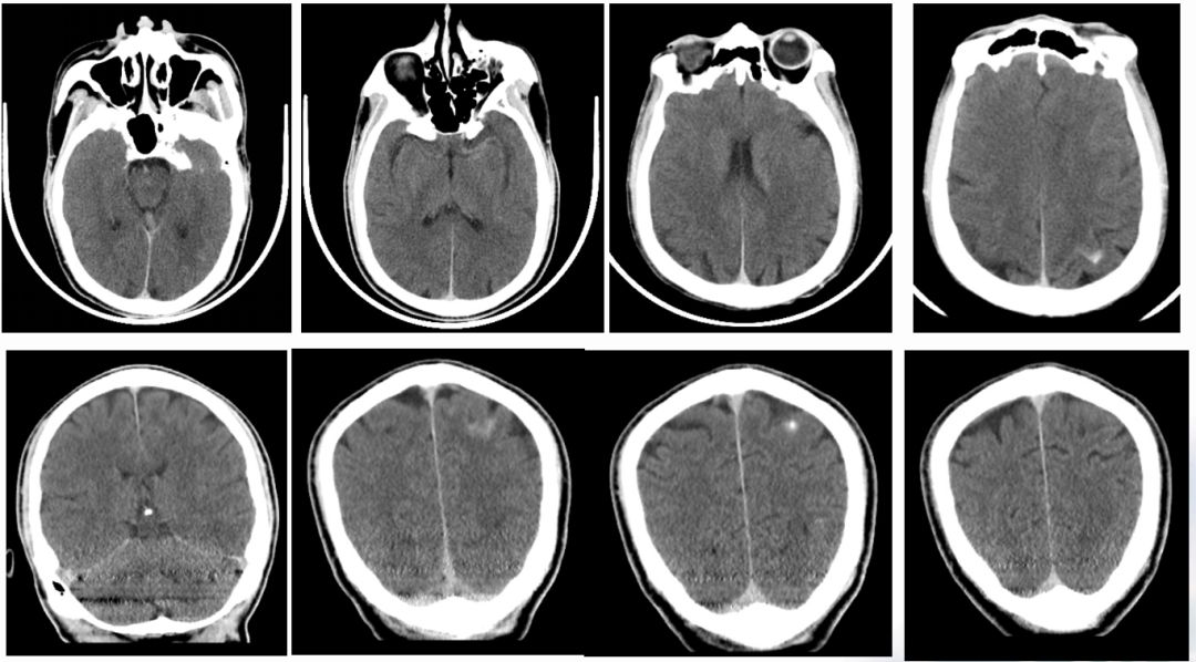 径技·例量|25期：再灌注出血—防不胜防