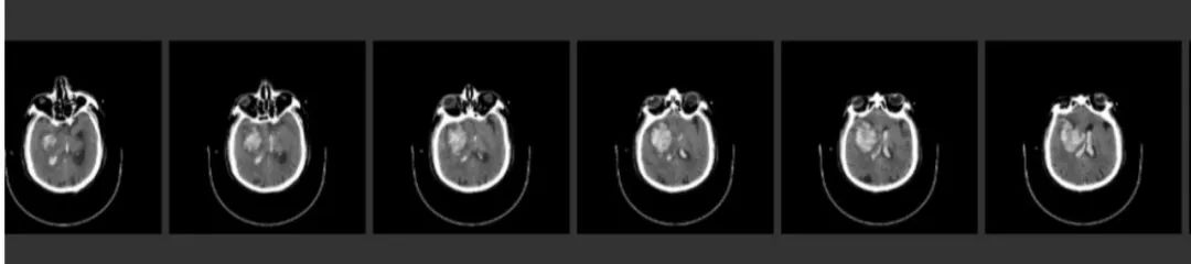 径技·例量|25期：再灌注出血—防不胜防