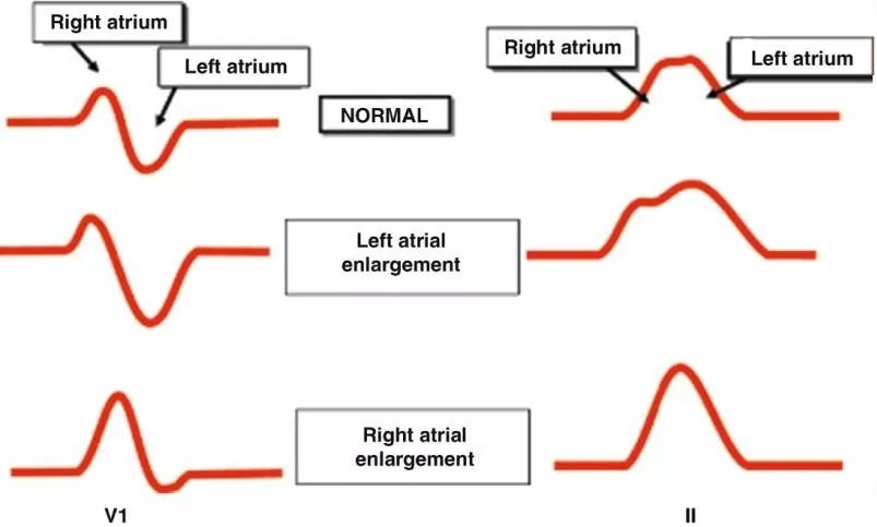 交替变化的P波，揭露房间传导的秘密｜识“图”寻踪