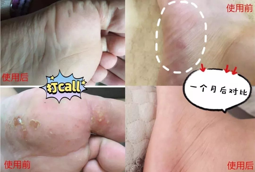 十年脚气怎么治才能除根,十年顽固脚气