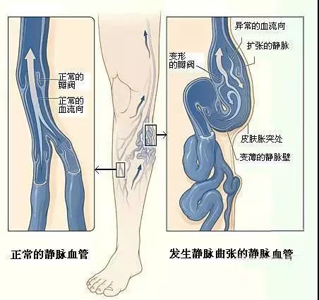 关于静脉曲张你知道多少?多图带你深入了解静脉曲张!