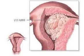 月经一直不干净就是子宫内膜癌吗,月经淋漓不尽是内膜癌吗