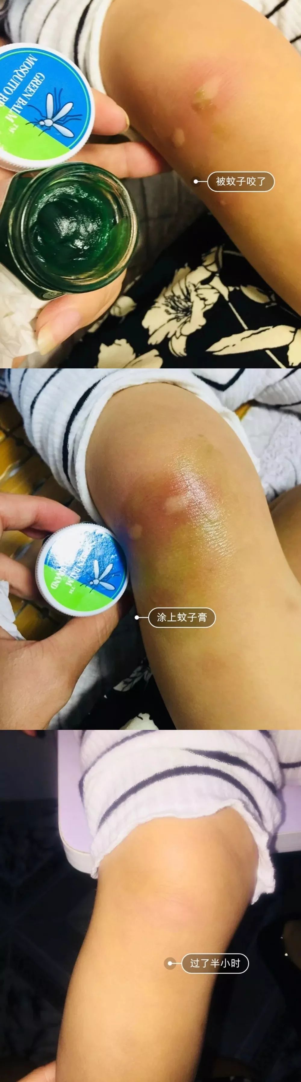 泰国蚊子叮咬止痒膏成人,蚊虫叮咬最管用泰国药膏