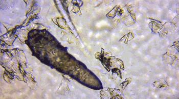 20分钟清理背部螨虫痘痘,十秒去除螨虫