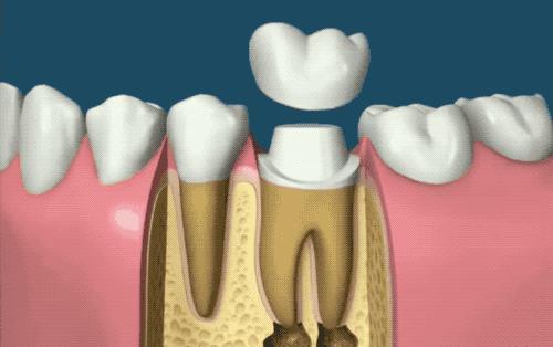 根管治疗没那么可怕,根管治疗有什么意义吗
