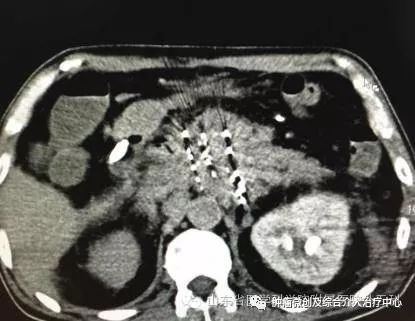 胰腺癌的介入治疗是什么意思？胰腺长瘤能活多久？-运城市第一医院肿瘤微创及综合介入科