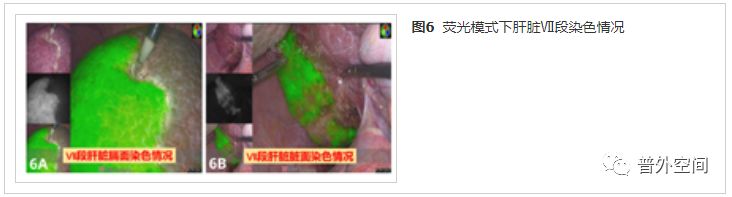 吲哚菁绿荧光引导腹腔镜解剖性肝脏Ⅶ段切除手术流程