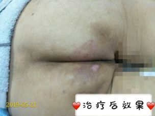 治疗特应性皮炎四步走,怎么快速抑制特应性皮炎的痒