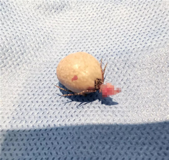 成人肚脐长小肉球,肚脐眼里面长了个肉球十几年